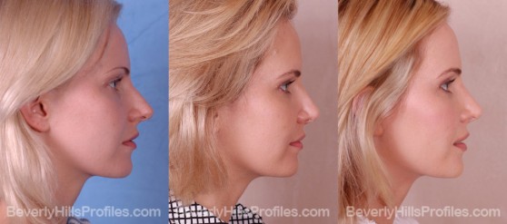 three photos before and after Rhinoplasty - profile view