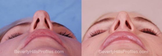 before and 1 year after open rhinoplasty for refinement of a bulbous tip