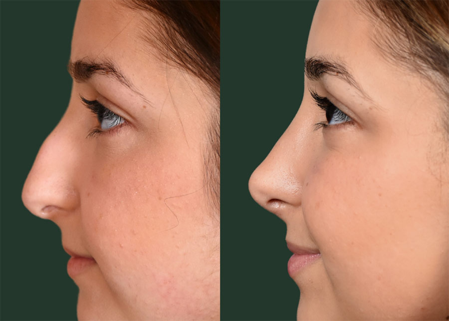 How long does swelling last after rhinoplasty?