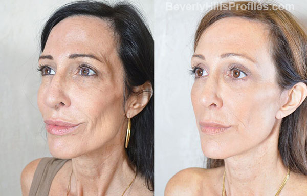 Female before and after Facelift - oblique view