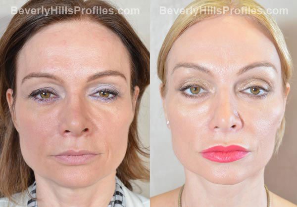 Female patient before and after Facelift - front view