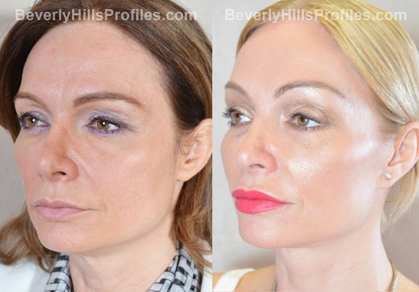 Female patient before and after Facelift - oblique view