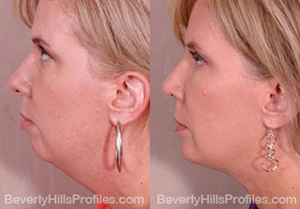 side view - Female patient before and after Facelift