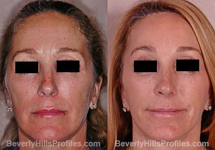 Female face, before and after Browlift treatment, front view, patient 4