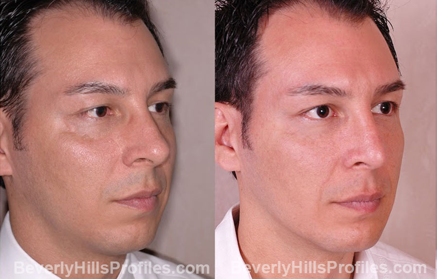oblique view male patient before and after Chin Implants