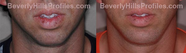 front view - Male patient before and after Chin Implants