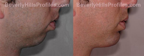 side view - Male before and after Chin Implants