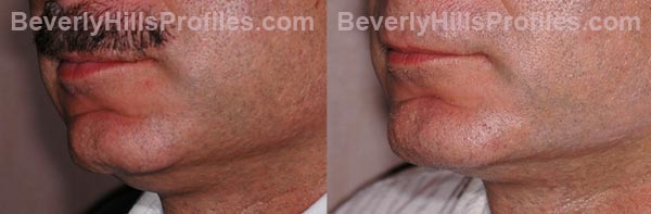Male before and after Chin Implants - oblique view