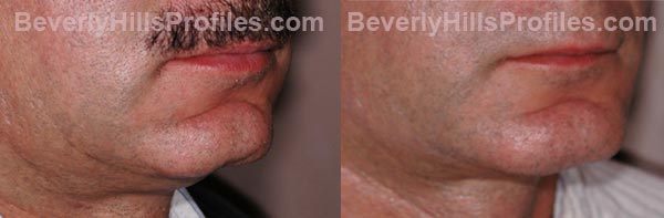 Male before and after Chin Implants - side view