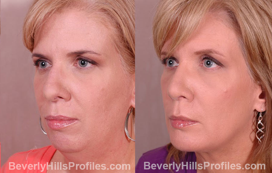 oblique view Female patient before and after Chin Implants