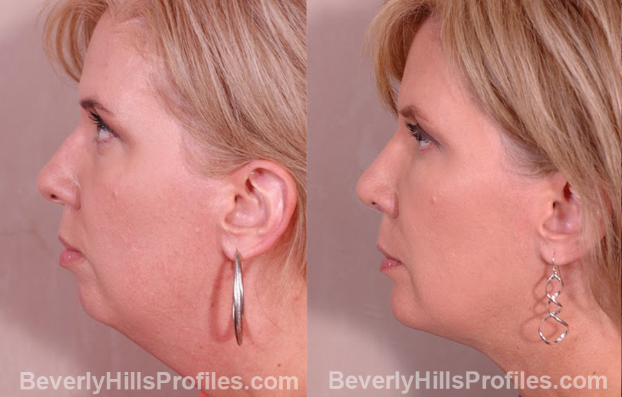side view Female patient before and after Chin Implants