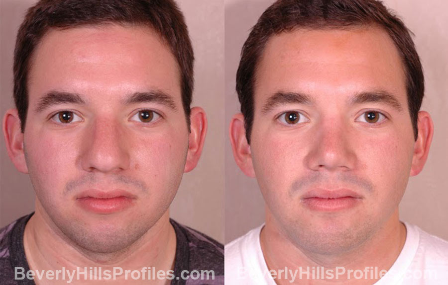 front view Male patient before and after Chin Implants