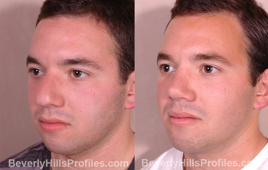 oblique view Male before and after Chin Implants