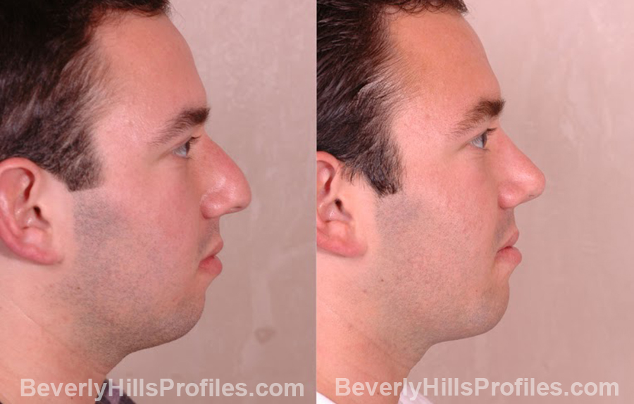 side view Male before and after Chin Implants