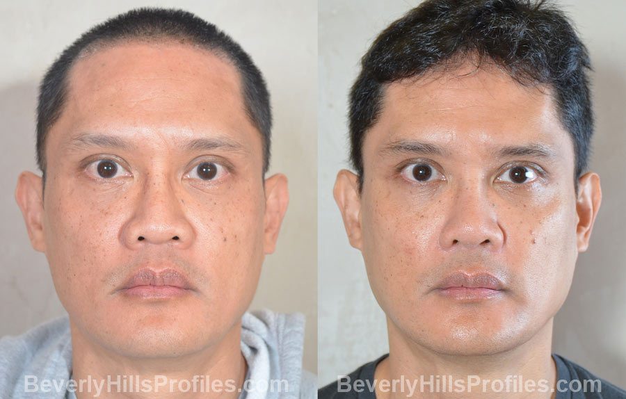 front photos - Male before and after Ethnic Rhinoplasty