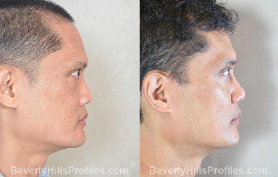 front photos - Male before and after Ethnic Rhinoplasty