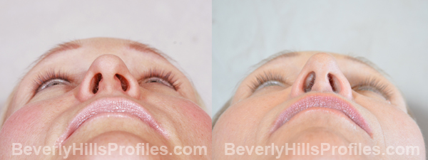 Female before and after Eyelid
