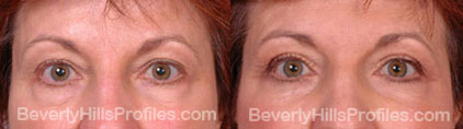 Female face, before and after Eyelid Lift treatment, front view, patient 5