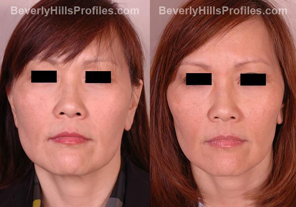 front view patient before and after Facelift