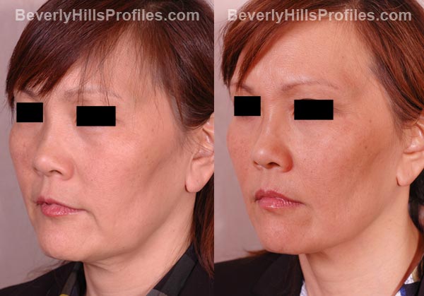 oblique view patient before and after Facelift