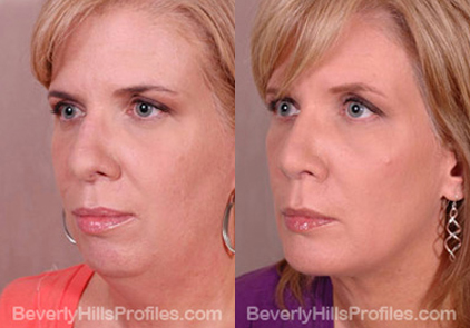 Female before and after Facial Fat Transfer - oblique view