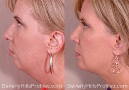 Female before and after Facial Fat Transfer - side view