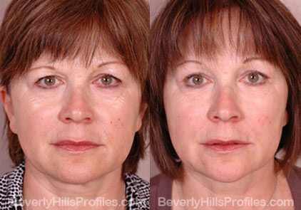 front view Female patient before and after Facial Peels
