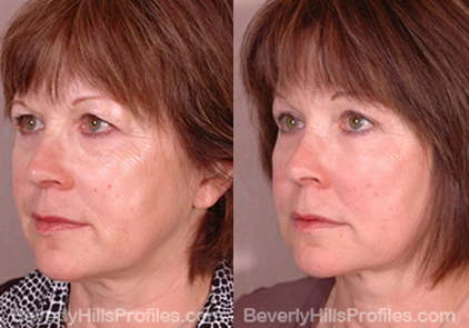 Female before and after Facial Fat Transfer Procedures - oblique view