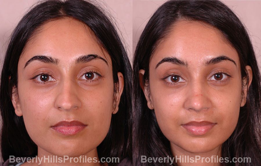 front photos Female patient before and after Rhinoplasty