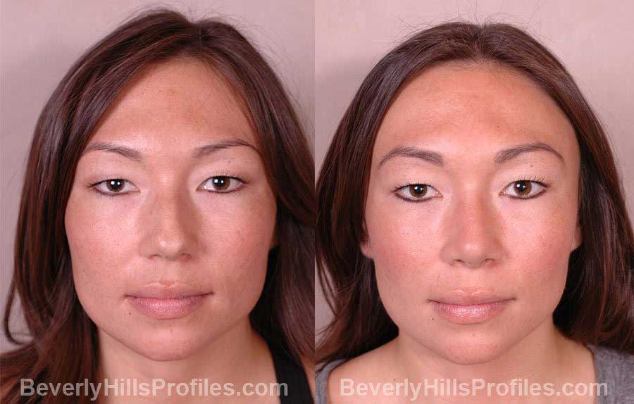 front photos Female before and after Nose Job