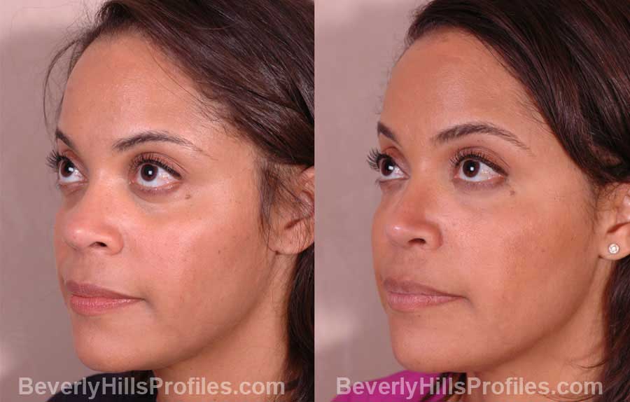 oblique view, Female patient before and after Nose Job