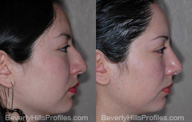 Female patient before and after Nose Job - side view