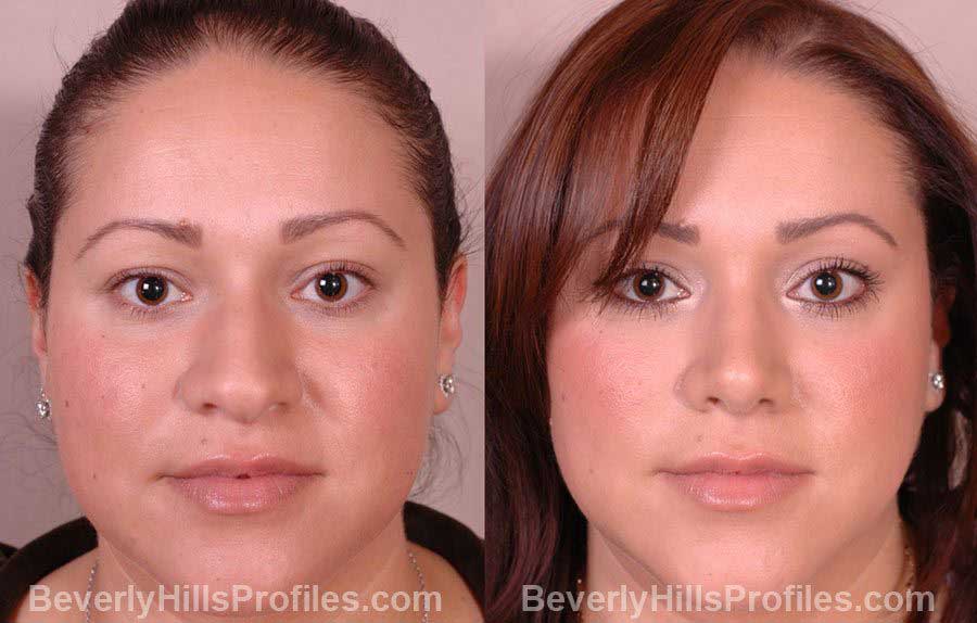 Female patient before and after Nose Job front view