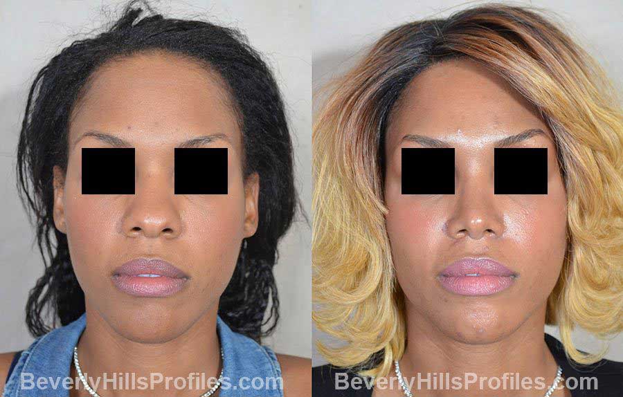 Female before and after Rhinoplasty, front view