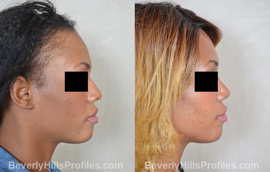 Female before and after Rhinoplasty, side view