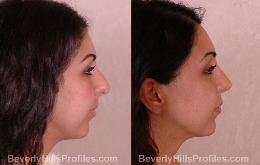 imgs Female before and after Nose Job - side view