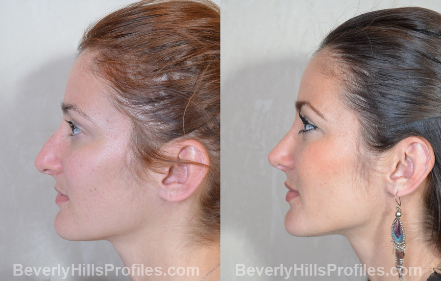 imgs Female before and after Nose Job oblique view