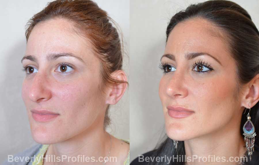 pics Female before and after Nose Job underside view