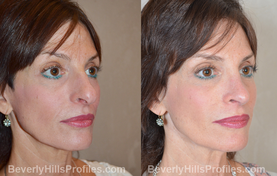 imgs Female before and after Nose Job, oblique view