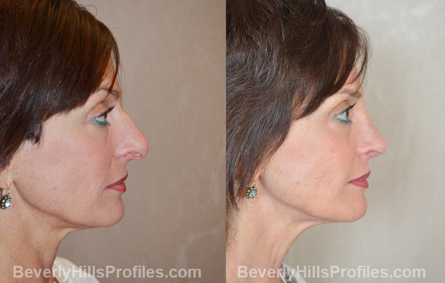 imgs Female before and after Nose Job, side view
