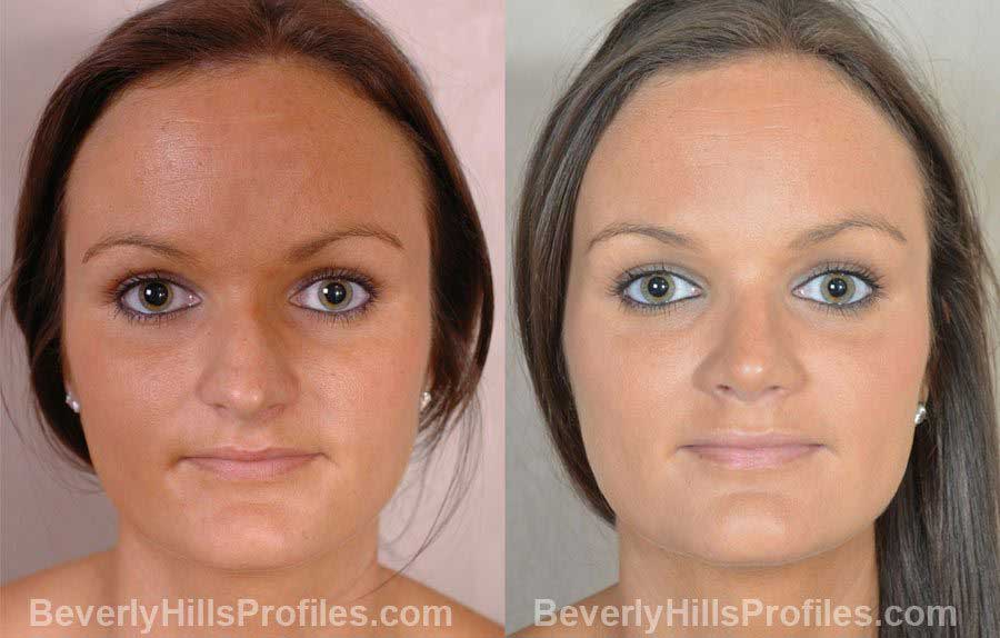 Female patient before and after Nose Job, front view