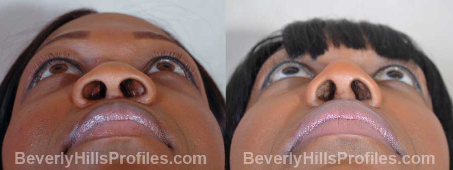 Female before and after Nose Surgery underside view