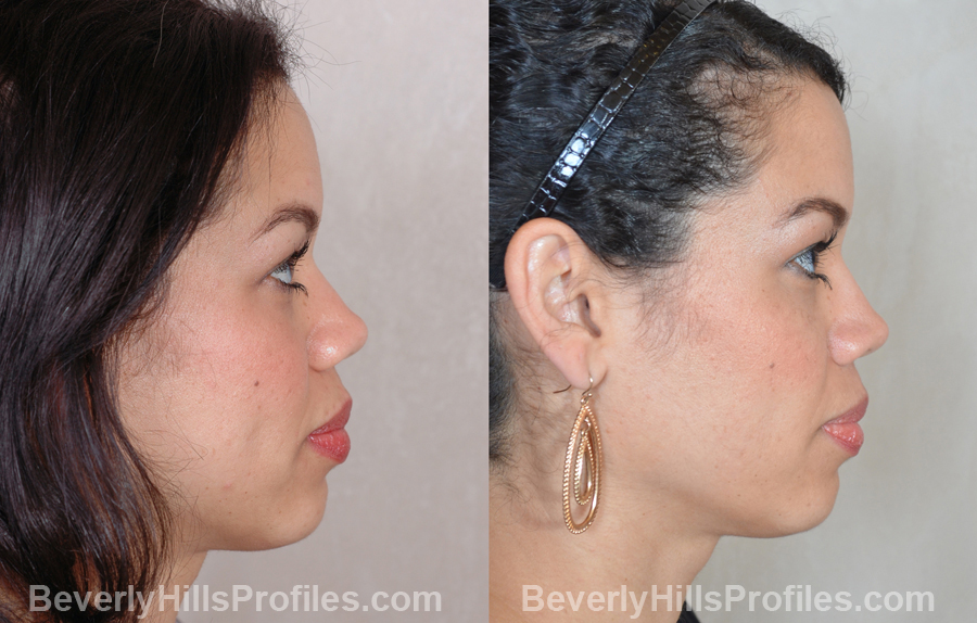Female before and after Nose Surgery, side view