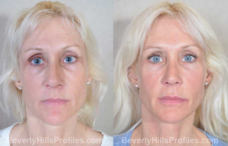 Female before and after Nose Surgery - front view