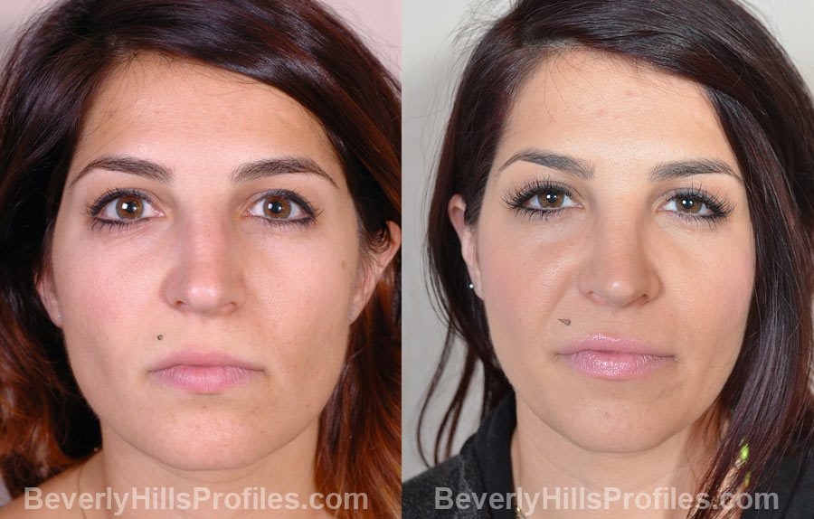 photos Female before and after Nose Surgery - front view