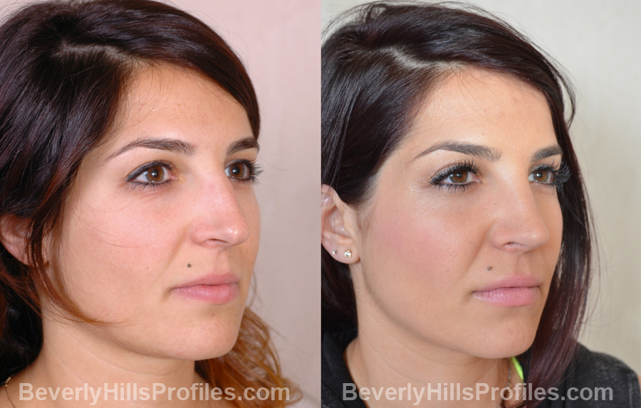 photos Female before and after Nose Surgery - oblique view