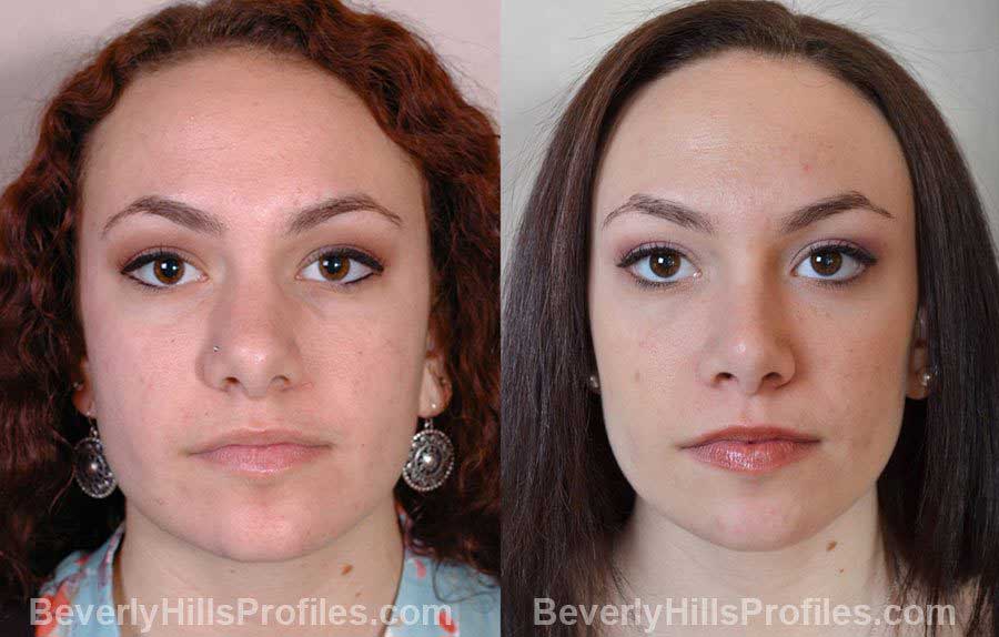 pics Female before and after Nose Surgery - front view