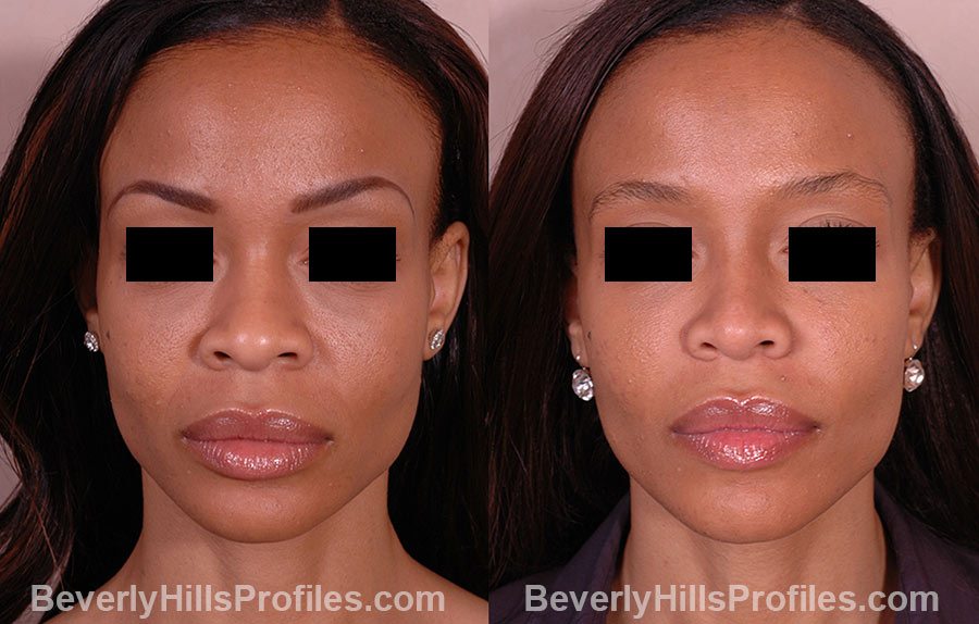 front view - Female before and after Rhinoplasty