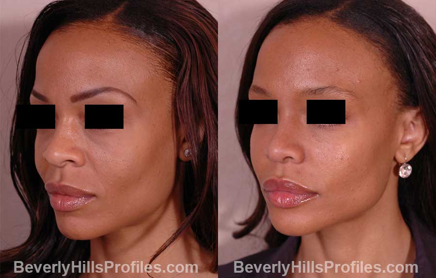oblique view - Female before and after Rhinoplasty