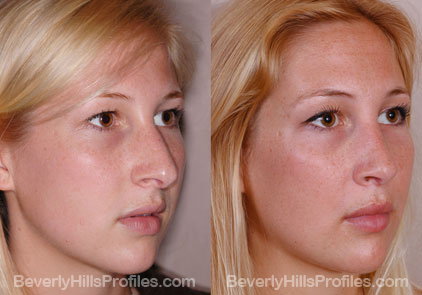 oblique view - Female patient before and after Rhinoplasty